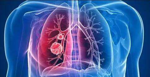 出现这十个症状 当心肺癌找上门