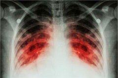 <b>肺癌患者骨转移怎么办？</b>
