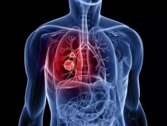 <b>肺癌患者肝脏转移怎么办？</b>
