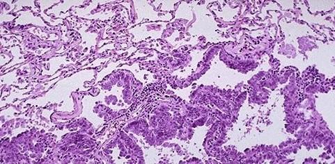 非小细胞肺癌II期治疗方案