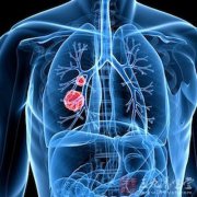 为什么大多数小细胞肺癌不做手术