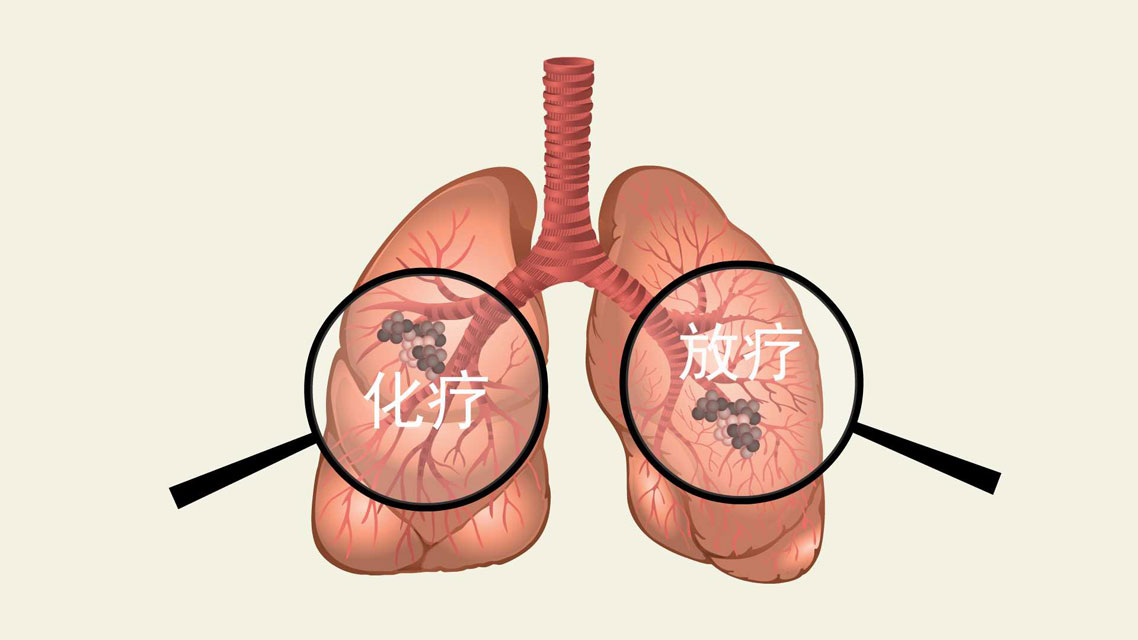 肺癌放疗的毒副反应有哪些？