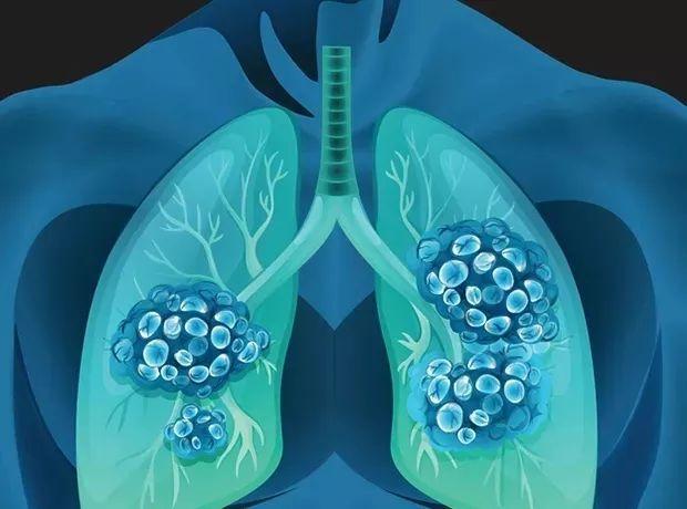放疗后肺癌病灶反而变大是怎么回事