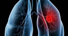 中期肺癌是什么意思