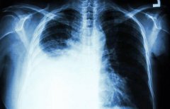 肺癌胸腔积水能活多久