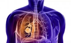 肺癌继发骨癌的疼痛特点有哪些