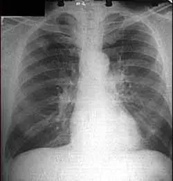 肺癌骨转移什么症状