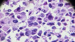 什么是非小细胞肺癌