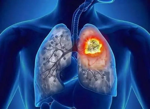 肺上有肿瘤危险吗
