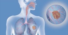 肺癌晚期死前症状有哪些