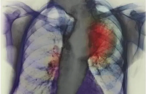肺鳞癌晚期有什么症状