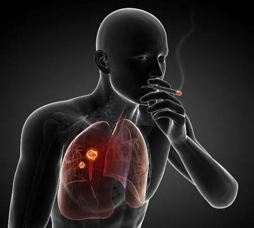 肺鳞癌是怎么引起的