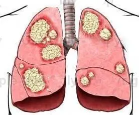 肺鳞癌容易转移吗