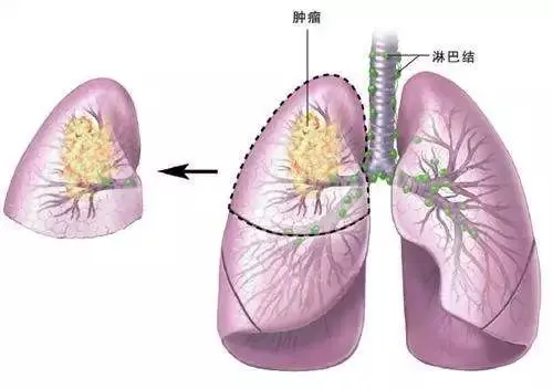 肺腺癌的特点