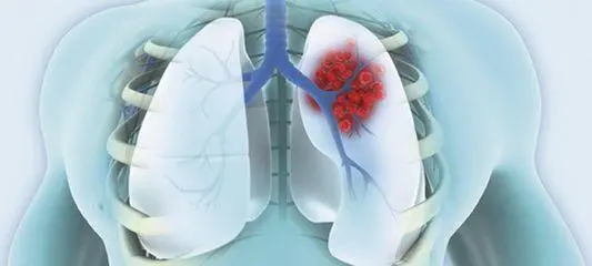 原发性肺癌的症状