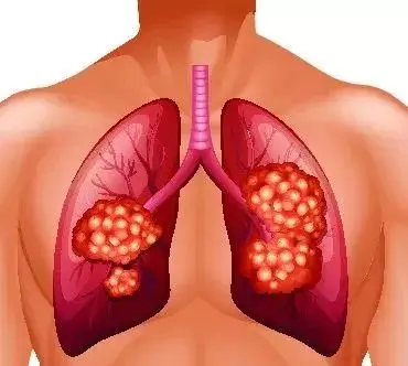 肺腺癌是怎么得的