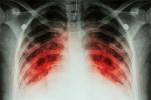 肺癌四期是最晚期吗