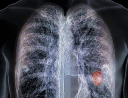 肺癌没有转移算哪期