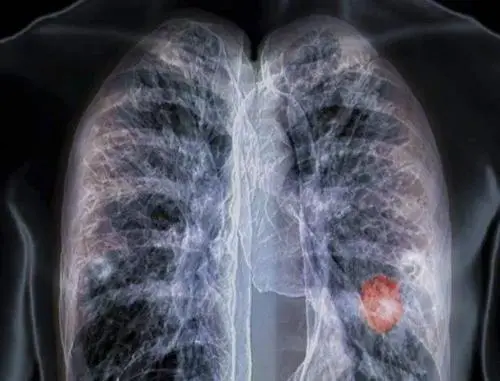 肺癌转移到骨头的症状