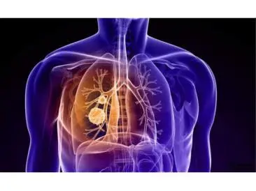 肺癌几期怎么判断