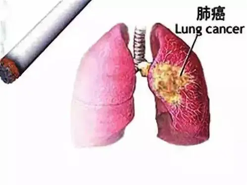 什么人会得肺癌