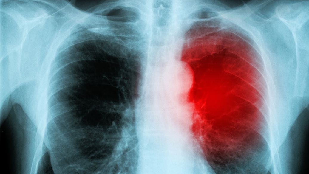 肺癌转移能活多久