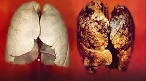 肺癌中晚期最多活多久