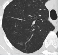 <b>胸部CT报告出现肺结节分叶征代表什么</b>