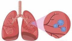<b>肺部结节有血管进入就可能是肺癌吗</b>