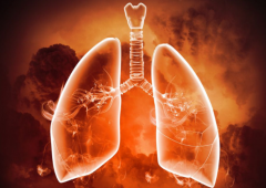 肺癌肿瘤完全切除后，肺癌还会复发吗？