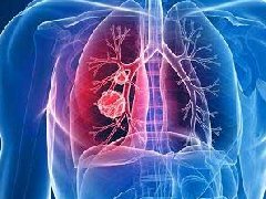 肺癌与遗传有关吗