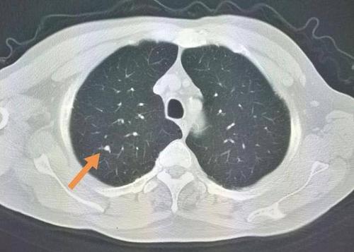我体检时发现肺部小结节，应该怎么办？