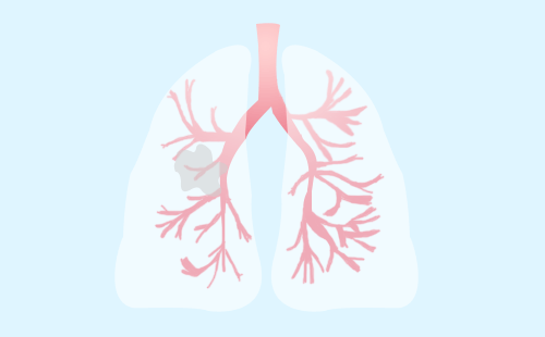 肺癌主要有几个类型