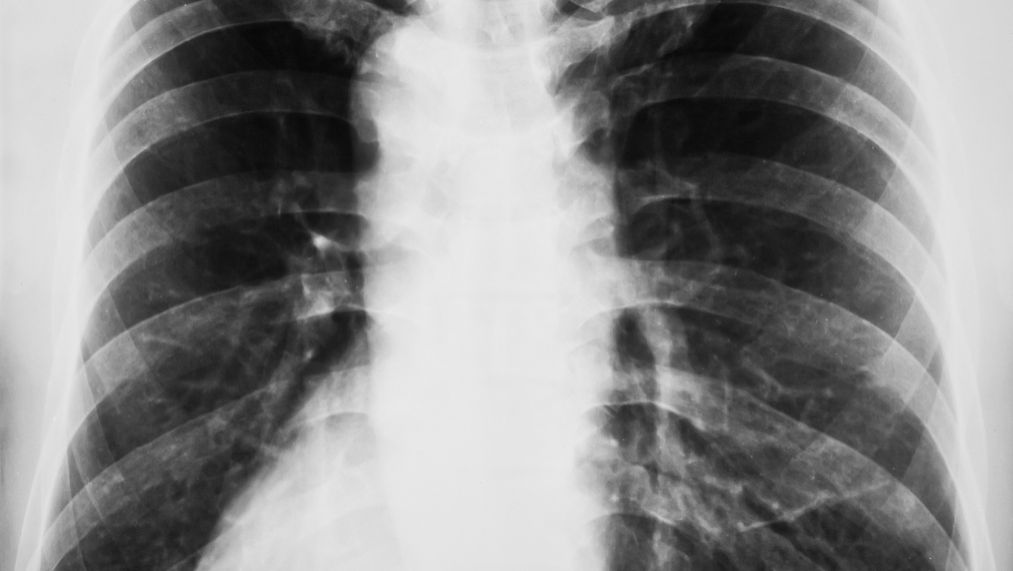 肺结核会导致肺