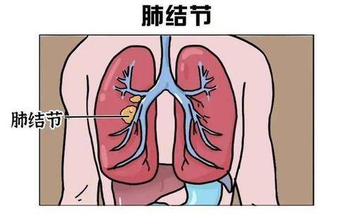 <strong>肺部结节一刀切可能是过度医疗</strong>