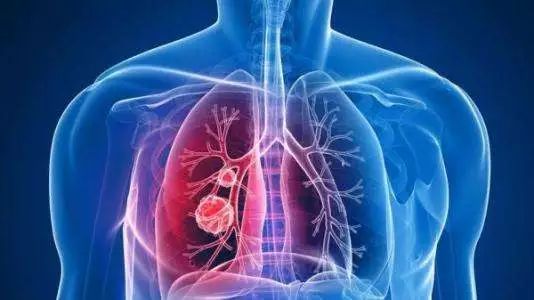 肺结节 可疑多原发肺癌的 初始治疗和辅助治疗