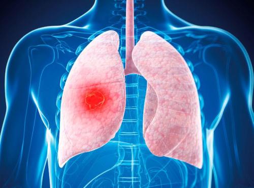 肺癌从早期到晚期的发展过程需要多久