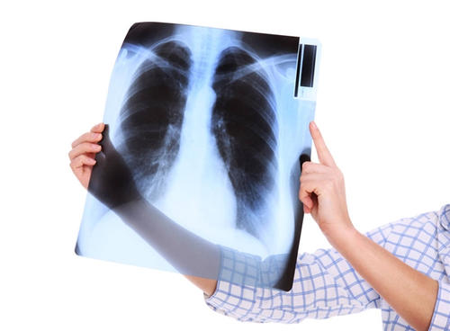 肺癌出现骨转移会有什么症状