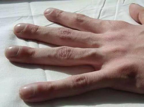 肺癌患者手指有什么变化