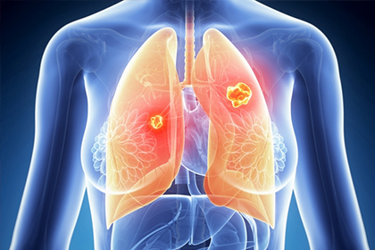肺癌的初期症状有哪些
