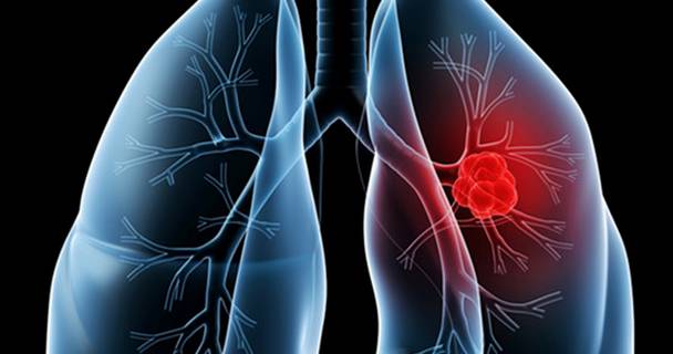 中期肺癌最多可以活多久