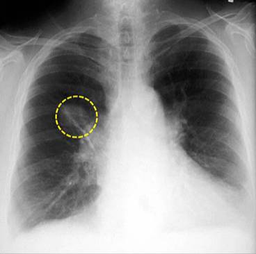 早期肺癌CT有什么表现