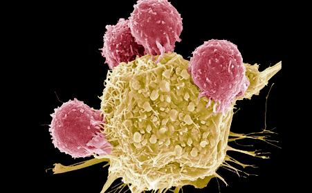 鳞状细胞癌能活多少年
