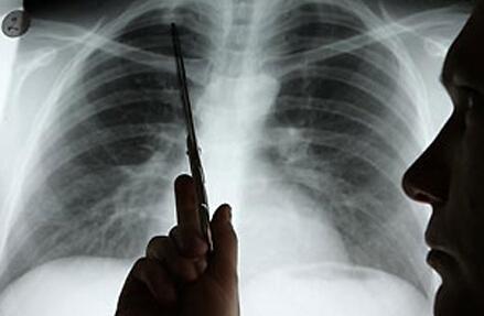 肺癌发生骨转移可以活多久