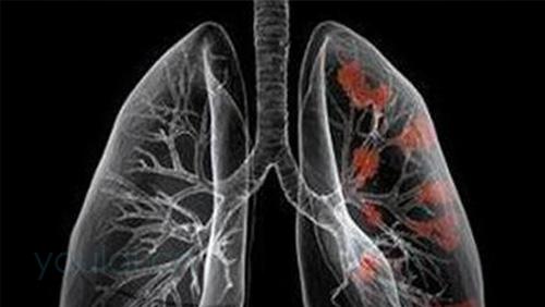 肺癌转移到淋巴是几期