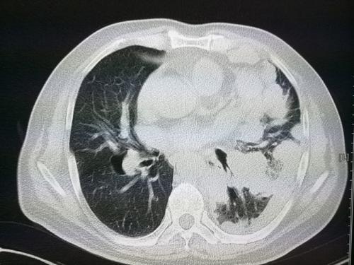 肺癌胸膜转移生存期多久