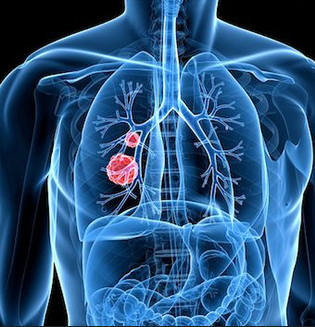 小细胞肺癌发展速度怎么样