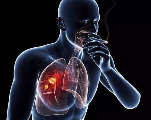 什么是肺腺癌