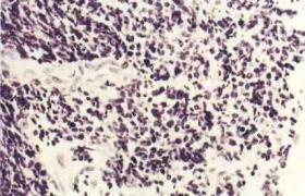 鳞状细胞癌抗原是什么意思