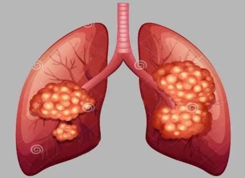 肺腺癌一般能活多久